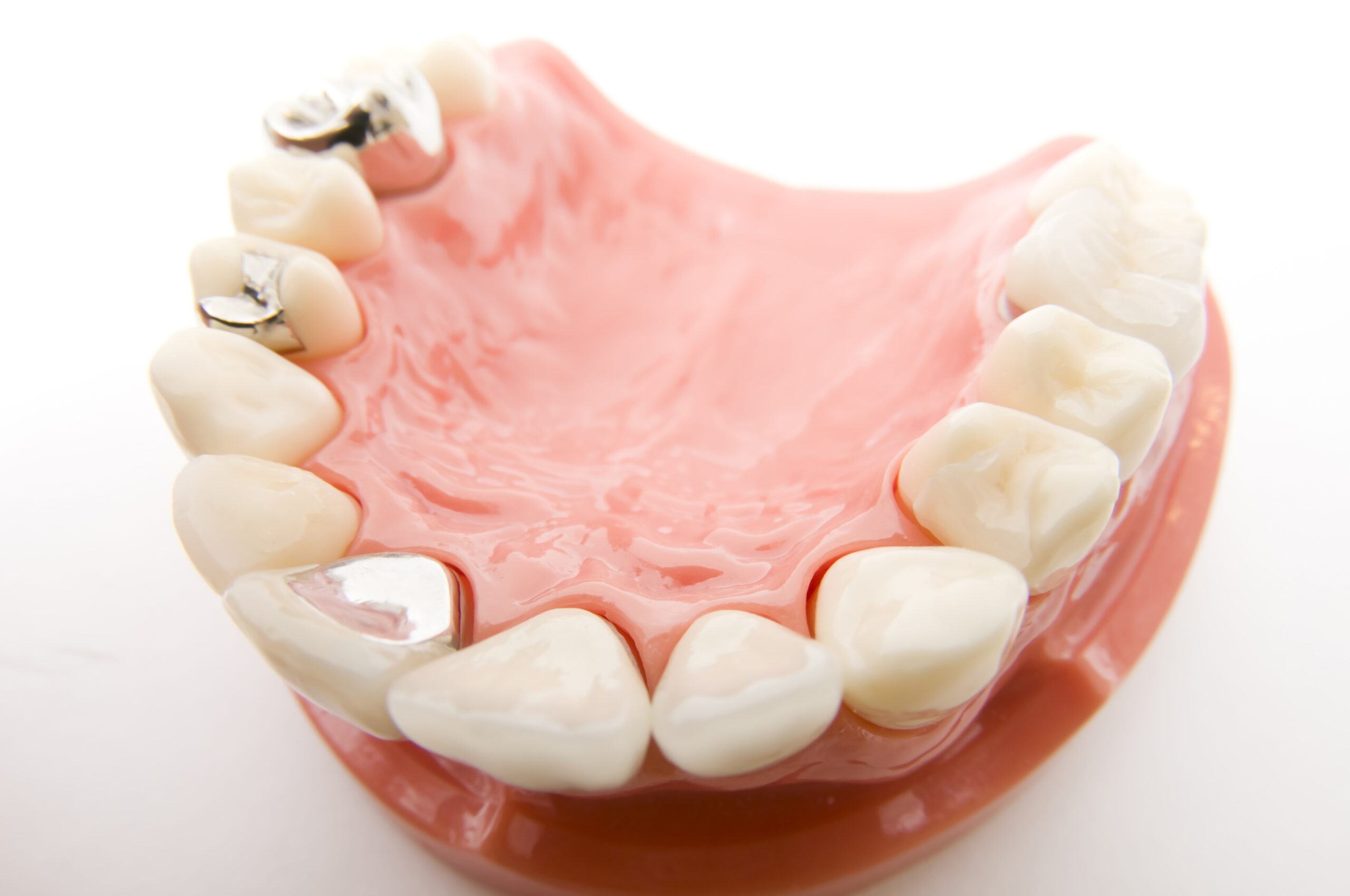 詰め物・被せ物・差し歯の違いは？種類を決めるときの注意点を解説！